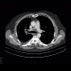 Lung tumour, postirradiation changes: CT - Computed tomography